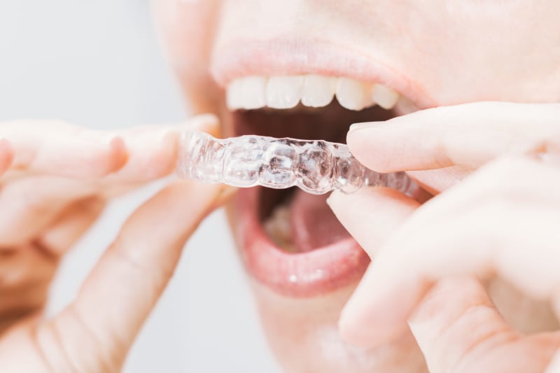 Invisalign Ahmedabad