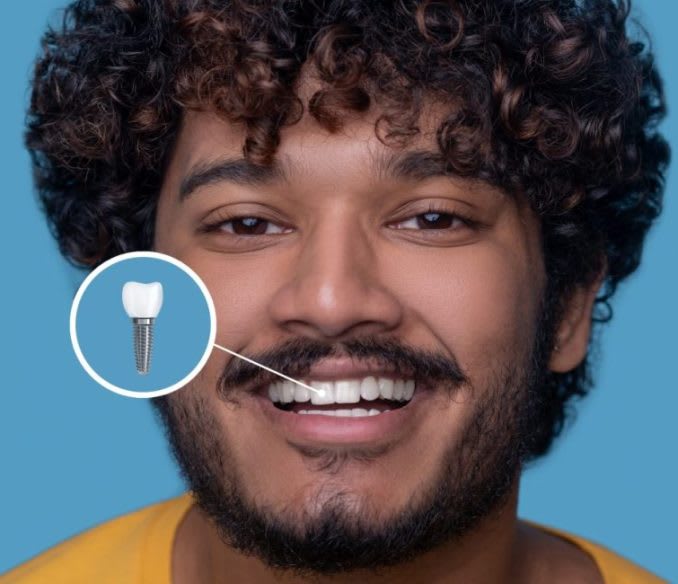 Dental Implants in Ahmedabad